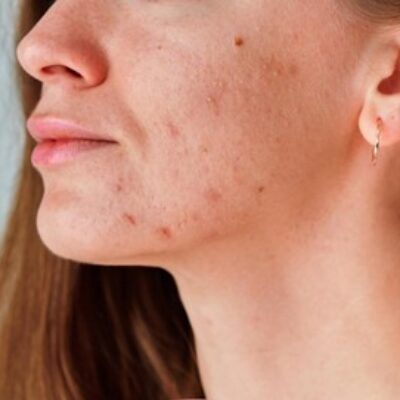 ¿El Dermapen realmente funciona para cicatrices de acné?